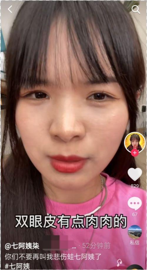 双眼皮失败视频,警惕术后风险与修复要点