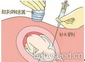 羊水穿刺视频,医学影像下的生命奥秘