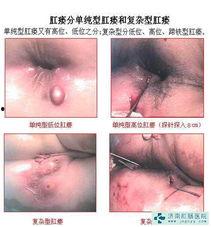 肛瘘图片大全,直观了解肛瘘形态与症状