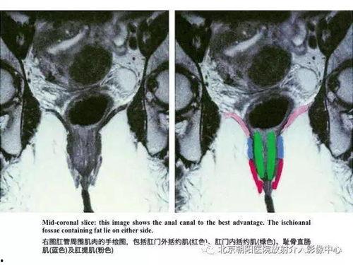 肛瘘图片大全,直观了解肛瘘形态与症状