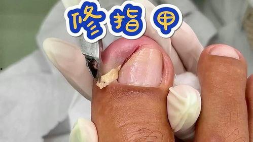 修脚趾甲视频,视频教程详解
