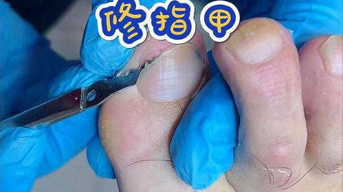 修脚趾甲视频,视频教程详解