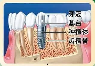 牙齿手术视频,专业视角下的牙科治疗实况