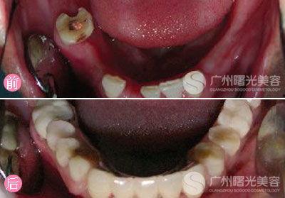 牙齿手术视频,专业视角下的牙科治疗实况