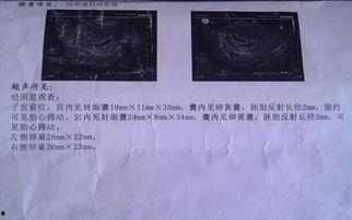 b超胎动视频,胎动视频见证宝宝成长瞬间