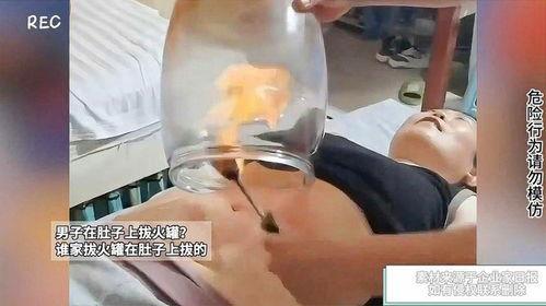 肚子拔罐视频,肚子上的秘密，轻松缓解多种不适