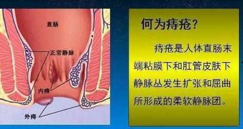女性混合痔疮手术视频,女性混合痔疮手术过程解析与康复指导