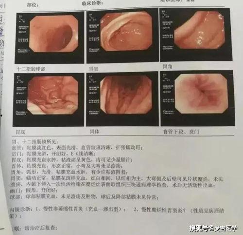 胃镜过程视频,全程视频解析